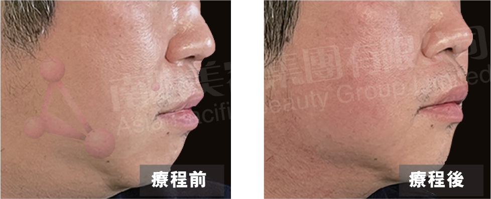 PIAMO Before and After Inmode Lift Firming Lipolysis Bunched Surface Oedema Fatty Surface Large and Small Surface PVP HIFER 4-Cyclic Plasticity Collagen Plasticity 4-Cyclic Focusing Pulsed Negative Pressure