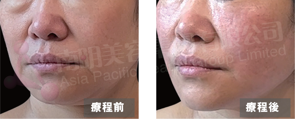 PIAMO Before and After Inmode Lift Firming Lipolysis Bunched Surface Oedema Fatty Surface Large and Small Surface PVP HIFER 4-Cyclic Plasticity Collagen Plasticity 4-Cyclic Focusing Pulsed Negative Pressure